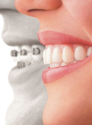 invisalign faqs