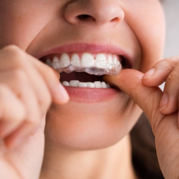 Smile with Clear Aligners