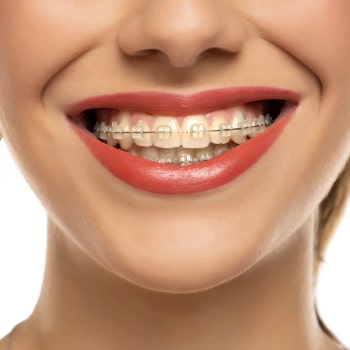 Smile with Clear (Ceramic) Braces