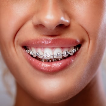 Smile with Traditional Metal Braces