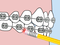 Poking wire adjustments infographics 